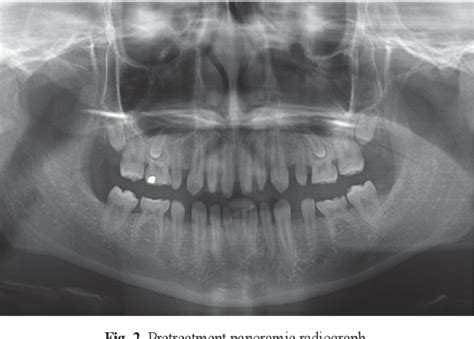 Figure 2 from A noninvasive esthetic treatment of isolated microdontia using new high ...