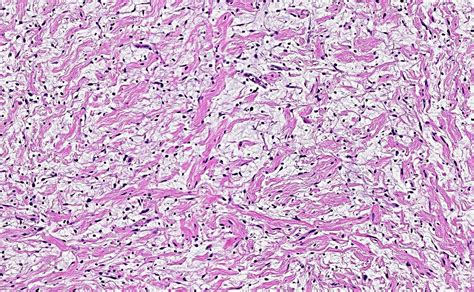 Plexiform Neurofibroma Histology