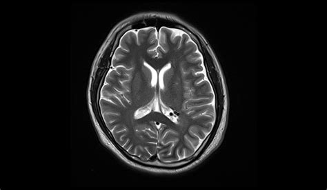 Sturge-Weber syndrome MRI | Radiology Article on Sturge-Weber syndrome