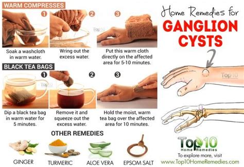 Más de 25 ideas increíbles sobre Ganglion cyst wrist en Pinterest ...