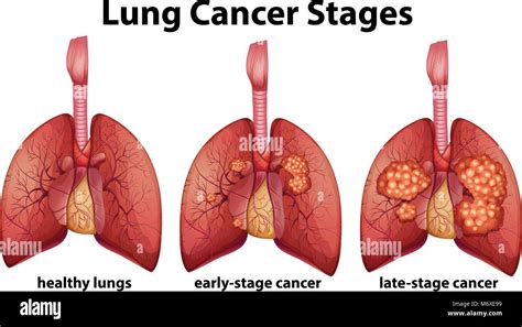 Lung Cancer Staging Diagram