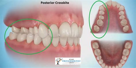 What Is A Crossbite? Signs, Effects, and Treatment - Miami Orthodontist Group