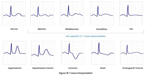 Step 8 of Interpretation of ECG-T-wave – medtigo