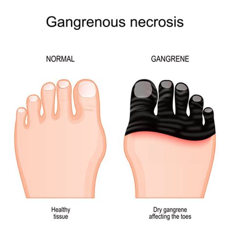 Gangrene Foot: Understanding the Causes and Prevention Strategies