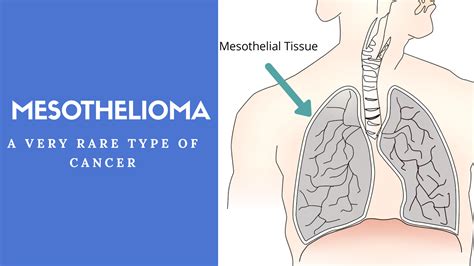 Mesothelioma: A Rare Type Of Aggressive Cancer - DrugsBank