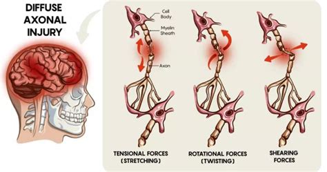 What is a Diffuse Axonal Injury?