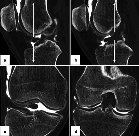 CT arthrography of the knee with ACL partial tear and bell hammer; CT ...