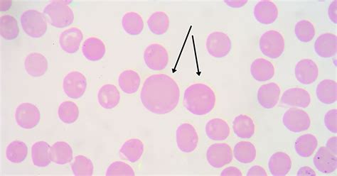 What Is Macrocytosis? - Facty Health