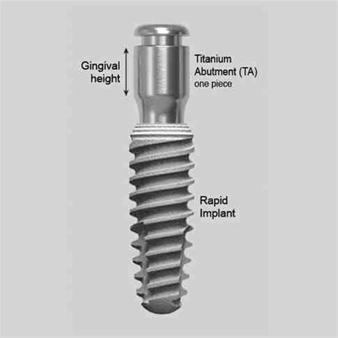 What is a titanium dental implant - Dental News Network