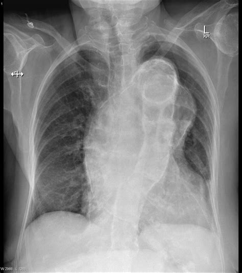 horacic aneurysms are often identified incidentally on imaging of the chest. A symptomatic ...