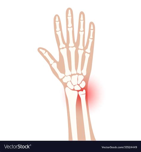 Fracture x ray concept Royalty Free Vector Image