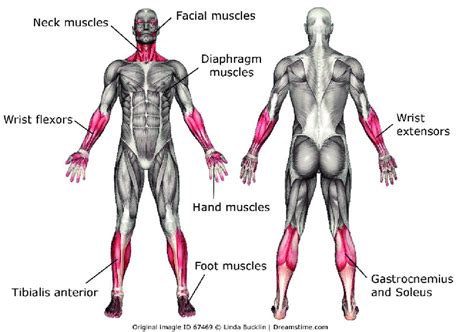 Muscles commonly affected in myotonic dystrophy type 1 (in red/dark ...