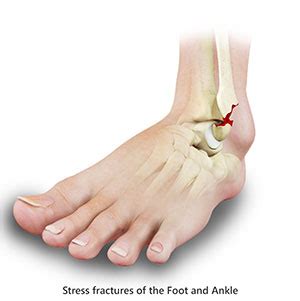 Stress Fracture of Foot & Ankle Milwaukee, Waukesha, Brookfield