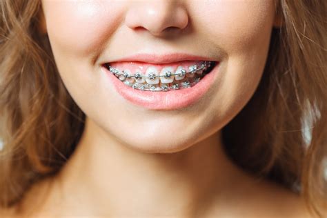 Ventajas de los brackets de autoligado – Clínica Dental Empecinado