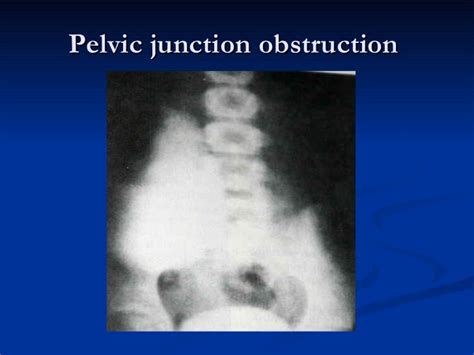 Urinary Outflow Obstruction