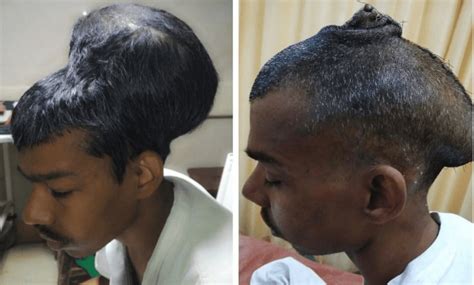 Doctors remove what's possibly world's largest brain tumor from Indian man's skull