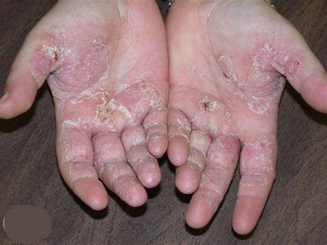 Eczema - Hand, Face, Baby, Causes, Symptoms & Treatment