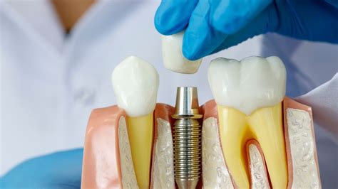 What Are Dental Implants: Everything You Need To Know | Byford Smiles