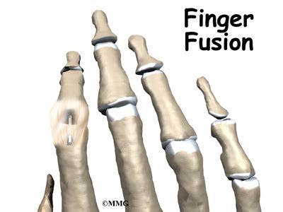 Finger Fusion Surgery | eOrthopod.com