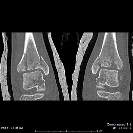 Tibial Plafond