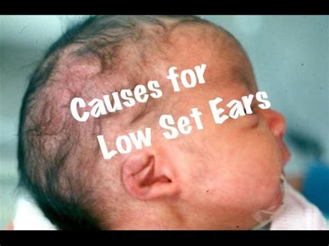 Quick Pediatrics: Causes for Low set ears - YouTube