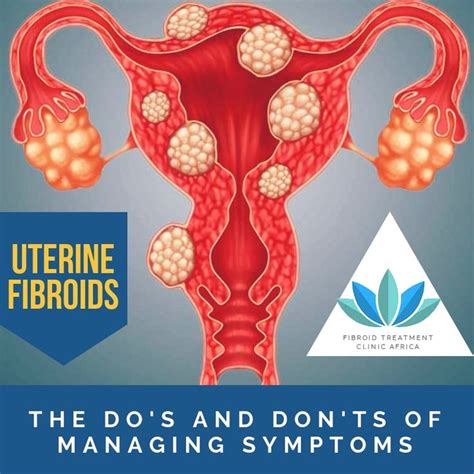 Uterine Fibroids: The Do's And Don'ts Of Managing Symptoms | Uterine fibroids, Fibroids, Symptoms