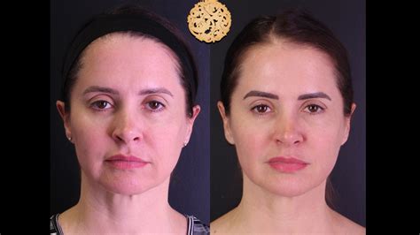 FaceTite Before And After Results | Nazarian Plastic Surgery