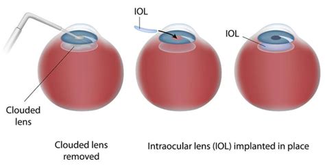 Intraocular Lenses (IOLs) - Information | Boston Eye Group