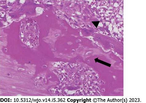 Microscopic findings of myositis ossificans. Haematoxylin and eosin ...