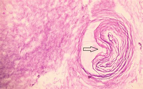 Histopathological examination (200×) of lesion showing keratin debris... | Download Scientific ...