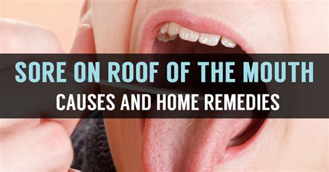 What is Roof of the Mouth Sore? Know its Causes & Remedies