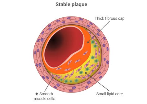 ATHEROSCLEROTIC PLAQUE VULNERABILITY | LIPID LINK