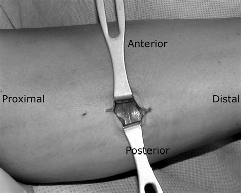 The Gastrocnemius Intramuscular Aponeurotic Recession: A Simplified ...