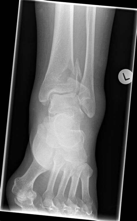 Ruedi and Allgower Classification of Pilon Fractures - wikidoc