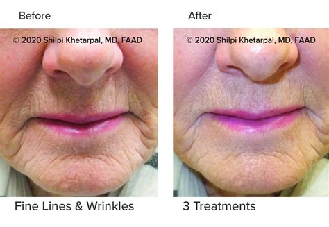 Microneedling with PRP - Colorado Dermatology Mohs Surgery