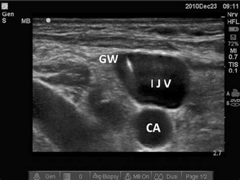 Comparison Of Ultrasound-guided Internal Jugular Vein And, 60% OFF