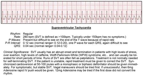 Acls Svt Rhythm Strip