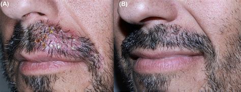 A Case of Persistent Beard Folliculitis - The American Journal of Medicine