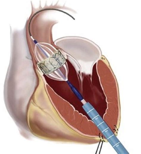 Transcatheter Aortic Valve Replacement Is Safe, Effective for Very ...