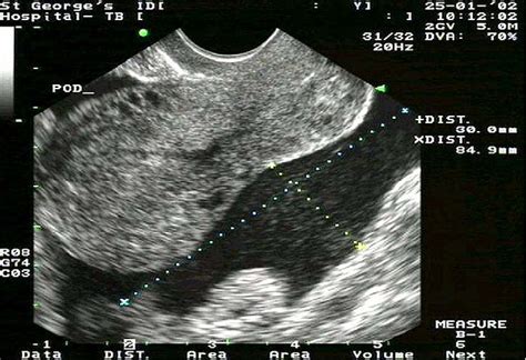 Figure 2 from Diagnosis of ectopic pregnancy with ultrasound ...