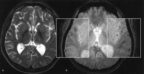 Fig 3. | Diffuse Axonal Injury Associated with Chronic Traumatic Brain Injury: Evidence from T2 ...