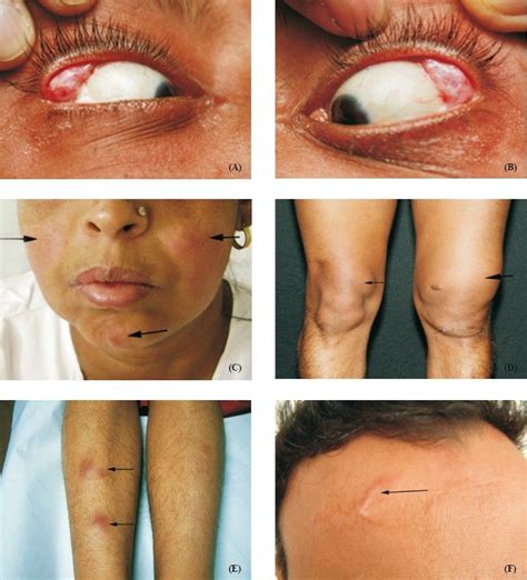 Figure 3: Clinical images in sarcoidosis. Bilateral lacrimal gland enlargement seen in a patient ...