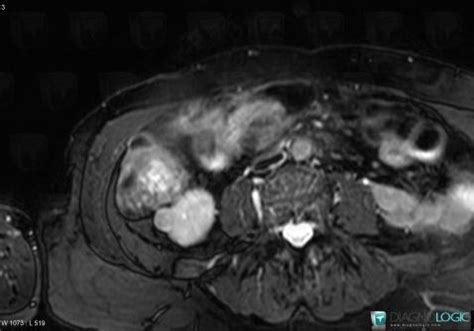 Radiology case : Angiomyolipoma (MRI) - Diagnologic