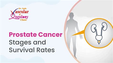 Prostate Cancer Survival Rate by Stage: What You Need to Know