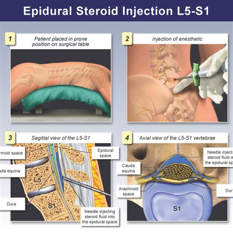 Epidural Steroid Injection Procedure - Trial Exhibits Inc.