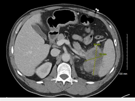 Computed tomography scan of the abdomen showing an 8.3 x 5.3 cm mass... | Download Scientific ...