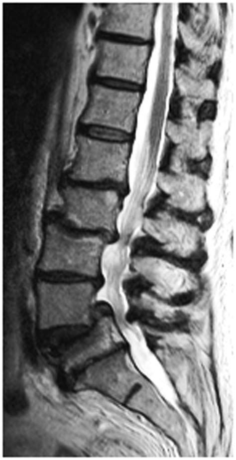 Herniated Disc Thoracic Mri