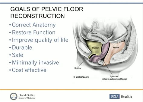 Pelvic Floor Repair Mesh Plications - Carpet Vidalondon