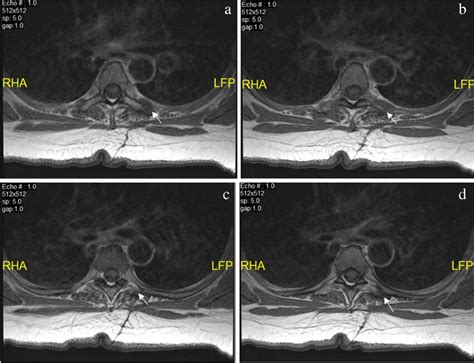 a–d MRI of thoracic spine axial T1 sequential images 1-year status post... | Download Scientific ...