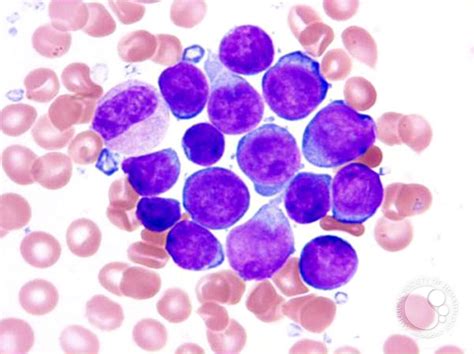 Precursor T-Lymphoblastic Leukemia/Lymphoma - 2.